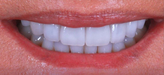 Cosmetic Dentistry – 3 After results