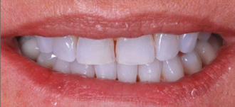 Cosmetic Dentistry – 3 Before results