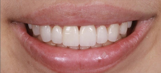 Cosmetic Dentistry – 4 After results