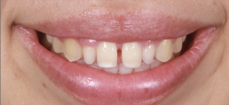 Cosmetic Dentistry – 4 Before results